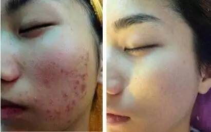 中医治疗痤疮，慎清热