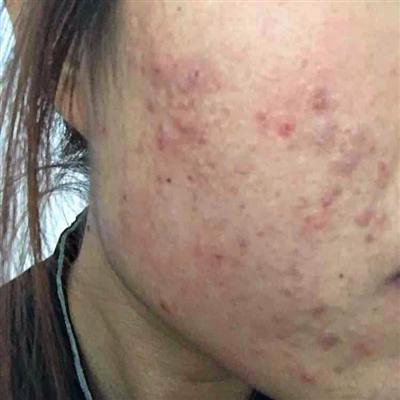 中医治疗痤疮需谨慎清热之道，痤疮调理新视角