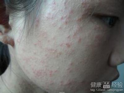 中医治疗痤疮，慎清热